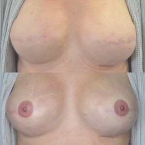 3D Nipple & Areola Tattoo - before and after