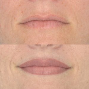 lip before & immediately after