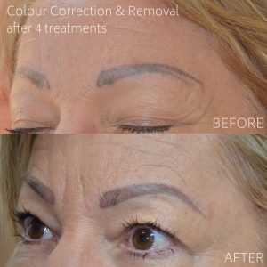 before and after - Cosmetic tattoo correction and removal 